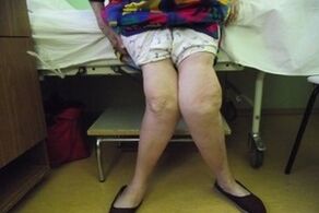 arthrosis កម្រិតខ្ពស់នៃសន្លាក់ជង្គង់